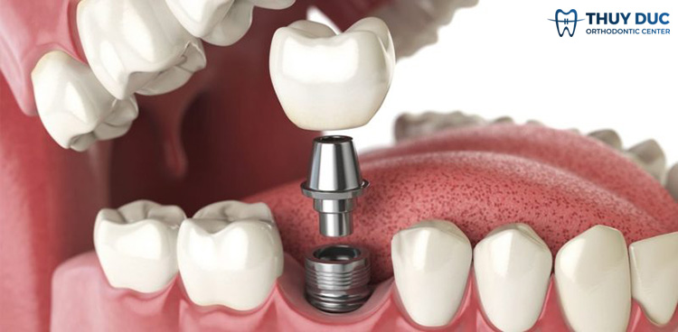 3. Cách khắc phục trồng răng implant bị giắt thức ăn 1