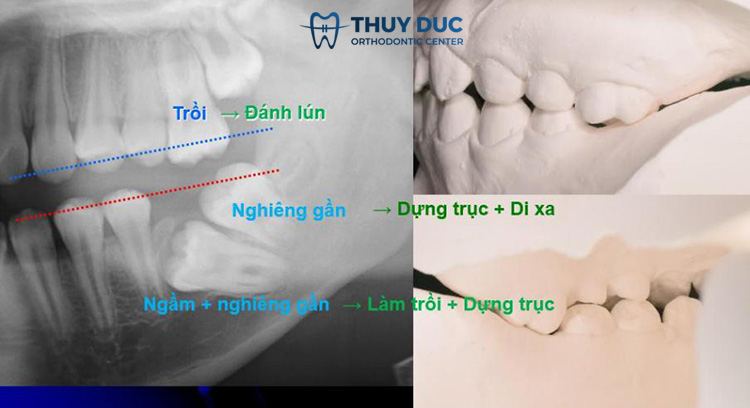 3. Cách khắc phục trồng răng implant bị giắt thức ăn 2