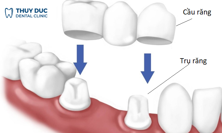 Cầu răng sứ là gì? 1 Cầu răng sứ là gì? 1
