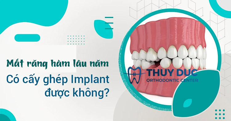 Mất răng hàm lâu năm có thể cấy ghép implant không? 1