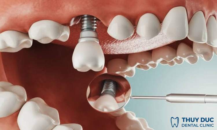 Cấy trụ Implant 1 Cấy trụ Implant 1