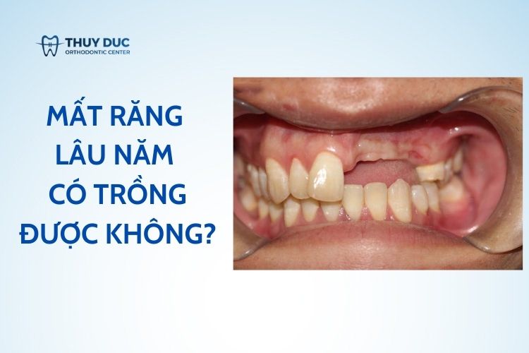 Mất răng lâu năm có trồng được không? 1 Mất răng lâu năm có trồng được không? 1