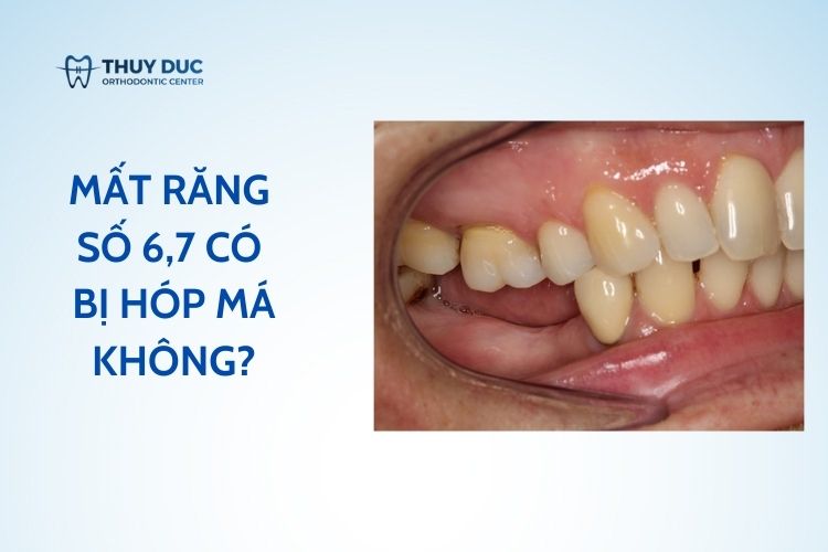 Mất răng số 6,7 có bị hóp má không? 1