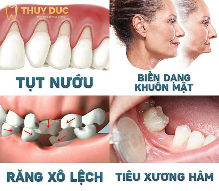Mất răng 6, 7 có nguy hiểm không? 1