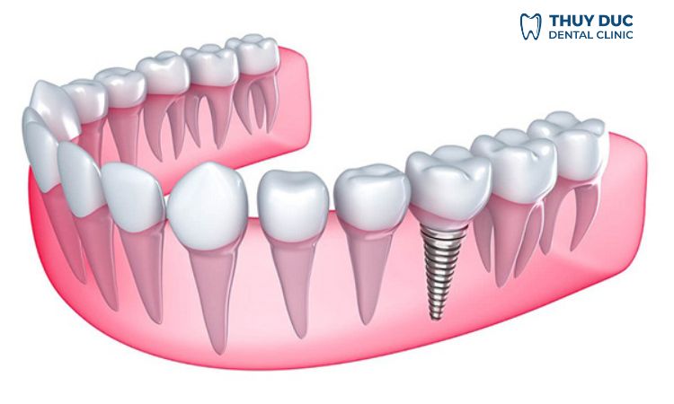 Trồng răng Implant 1