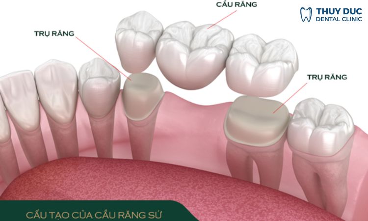 Làm cầu răng sứ 1