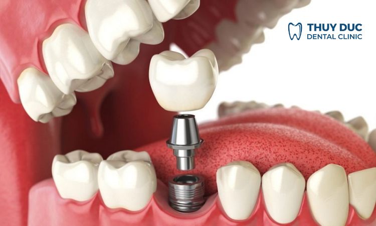 Trồng răng Implant 1