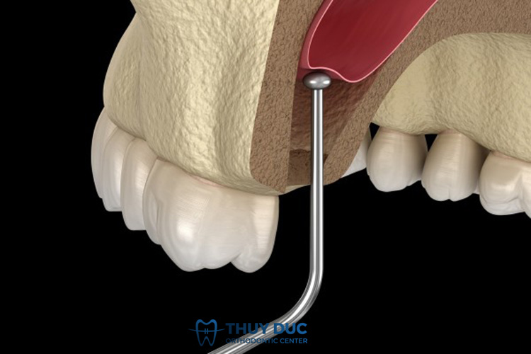 Nâng xoang trong trồng răng implant là gì? 1