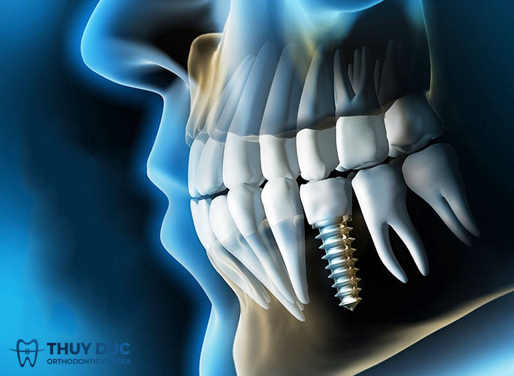 Do sự thay đổi tiếp xúc điểm qua thời gian giữa implant với răng thật 1