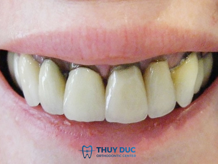 Nhược điểm của bọc răng sứ Inox 1 Nhược điểm của bọc răng sứ Inox 1