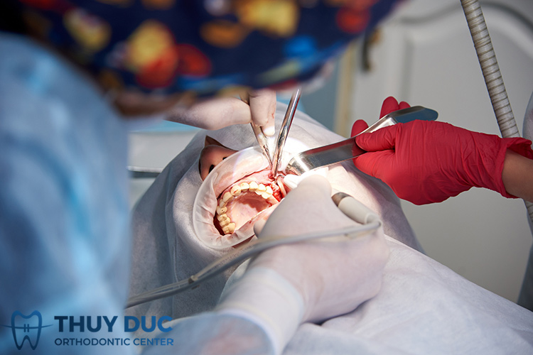 Quy trình cấy ghép implant nâng xoang kín 1