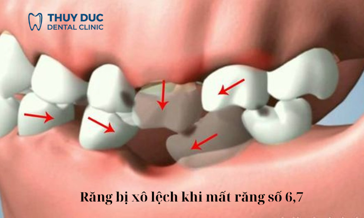 Viêm nhiễm răng miệng 1