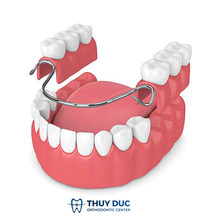 1. Răng giả tháo lắp có tốt không? 1 1. Răng giả tháo lắp có tốt không? 1