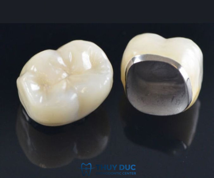 1. Bọc răng sứ Inox là gì? 1 1. Bọc răng sứ Inox là gì? 1