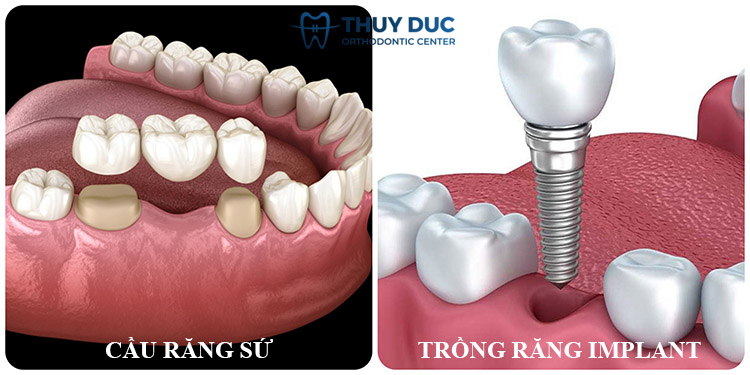 3. So sánh trồng răng implant và cầu răng sứ 1 3. So sánh trồng răng implant và cầu răng sứ 1