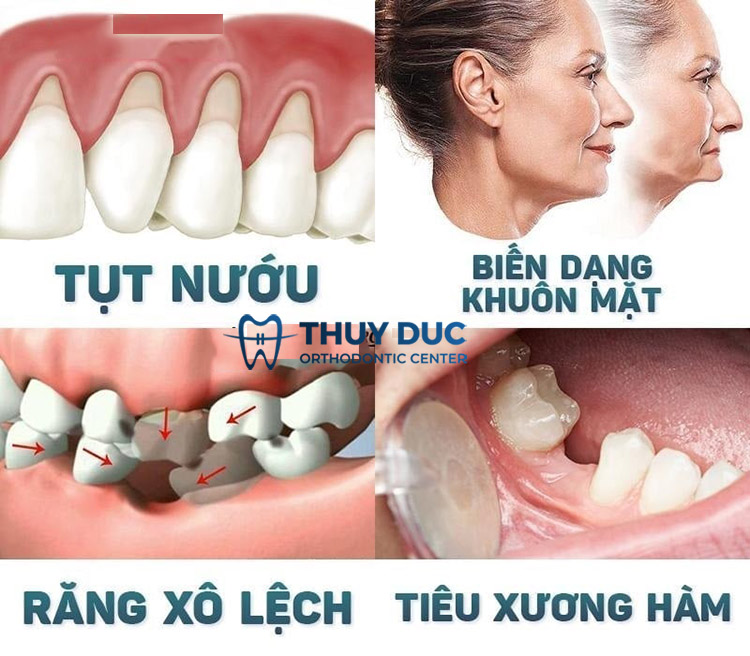 Tác hại do mất răng hàm lâu năm 1