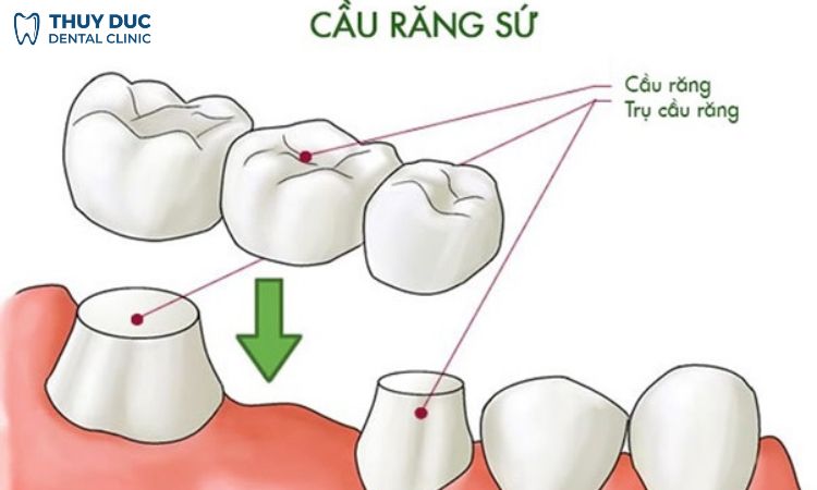 Trồng răng bắc cầu là gì? 1 Trồng răng bắc cầu là gì? 1