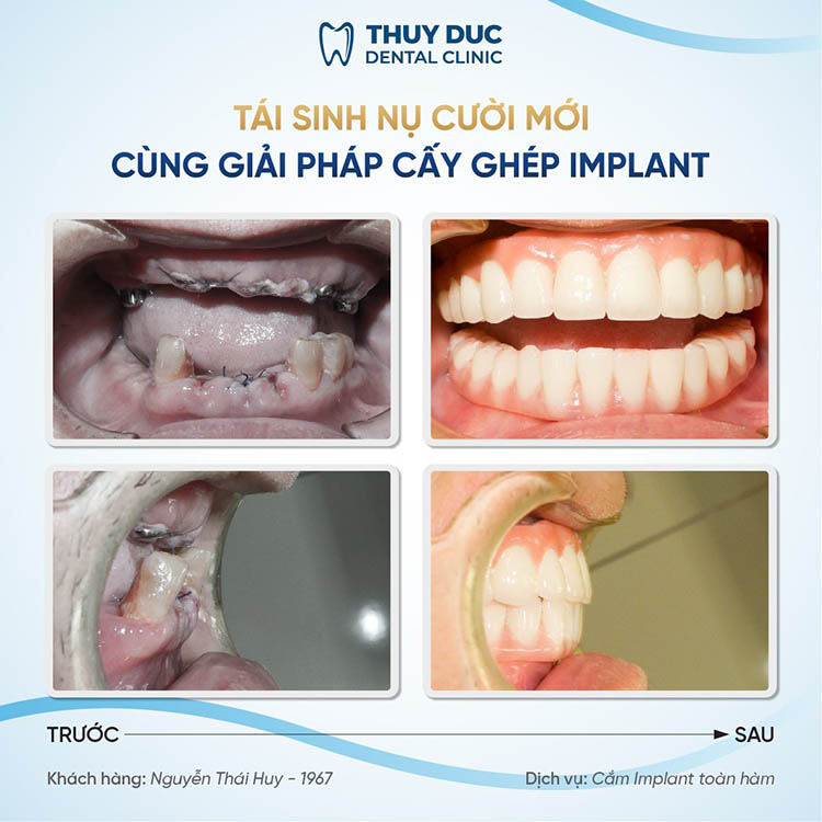 5. Mách bạn địa chỉ trồng răng an toàn, chất lượng cho người già 2