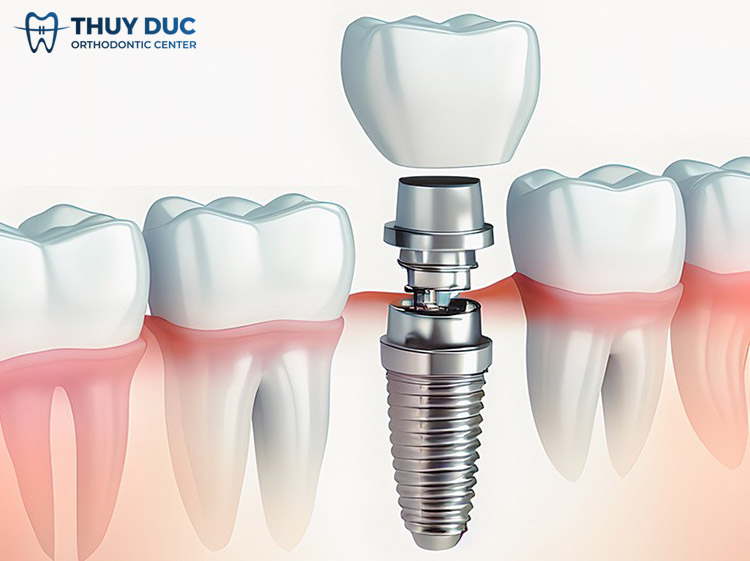 Trồng răng implant 1
