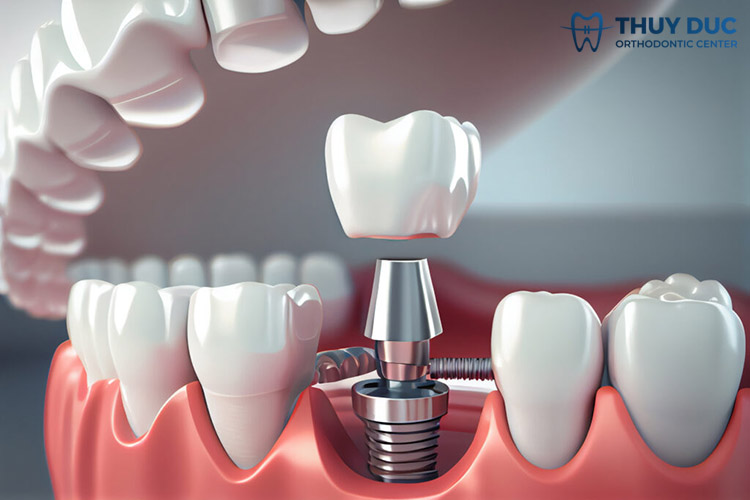1. Trồng răng implant là gì? 1 1. Trồng răng implant là gì? 1