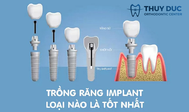 Nên trồng implant loại nào tốt nhất hiện nay? 1