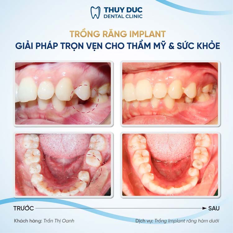 4. Địa chỉ trồng răng implant an toàn, chất lượng 2
