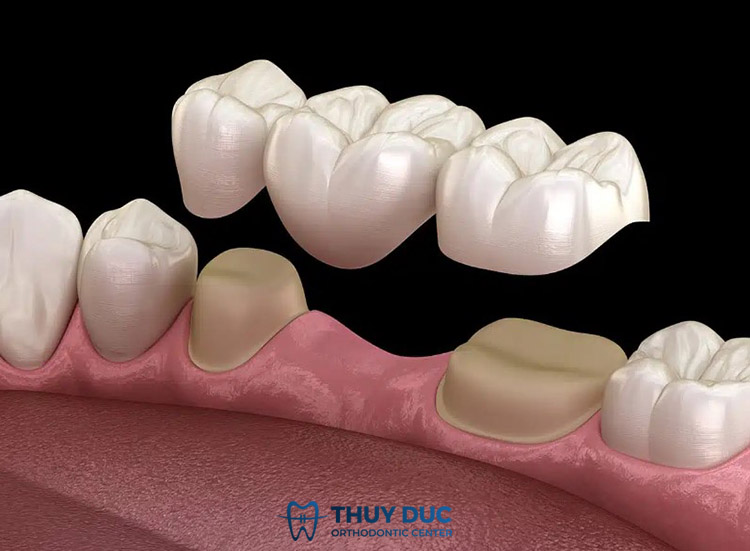 1. Trồng răng sứ bắc cầu là gì? 1