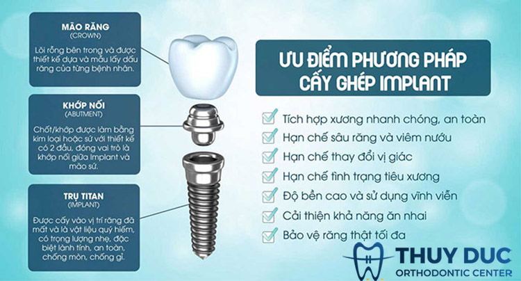 Ưu điểm của trồng răng Implant 1