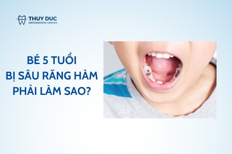 Phải làm sao khi bé 5 tuổi bị sâu răng hàm? 1