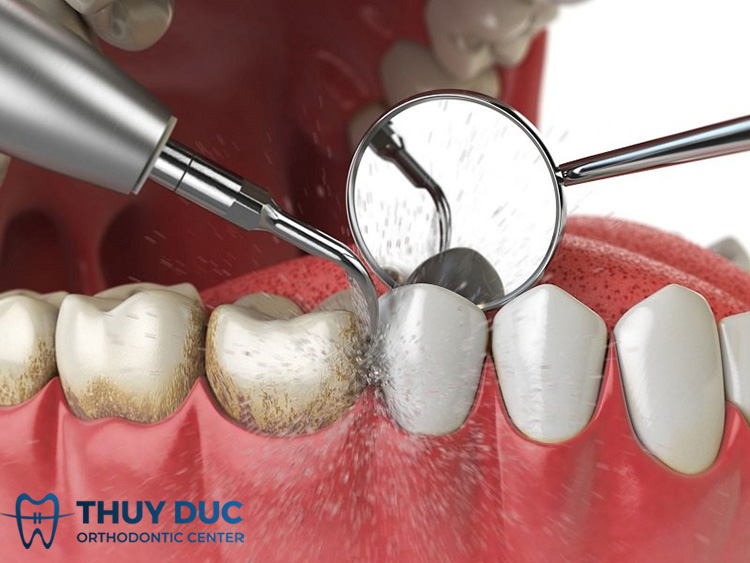 Cạo vôi răng bằng máy thổi cát 1 Cạo vôi răng bằng máy thổi cát 1