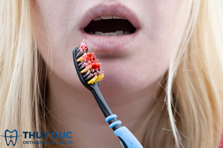 Đánh răng bị chảy máu có sao không? Cách khắc phục 1 Đánh răng bị chảy máu có sao không? Cách khắc phục 1
