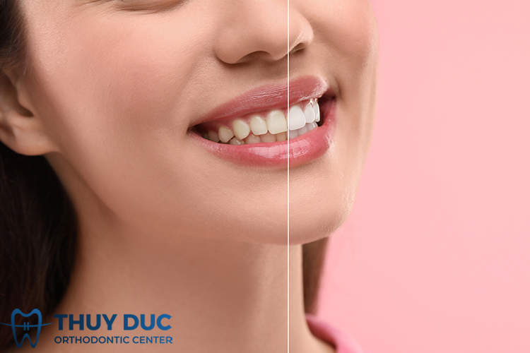 Làm trắng răng bằng muối bao lâu thì có tác dụng? 1 Làm trắng răng bằng muối bao lâu thì có tác dụng? 1
