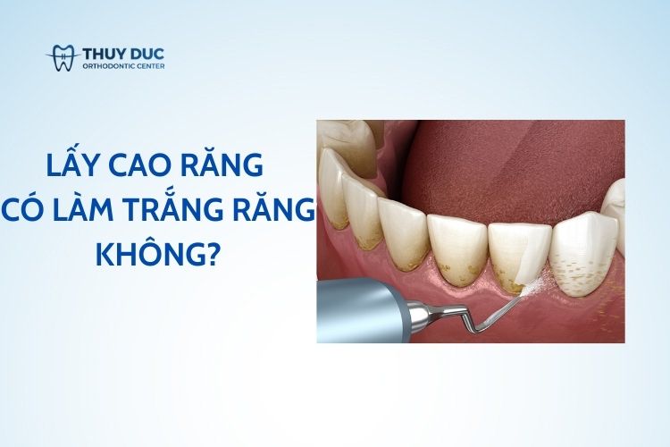 Lấy cao răng có làm trắng răng không? 1 Lấy cao răng có làm trắng răng không? 1