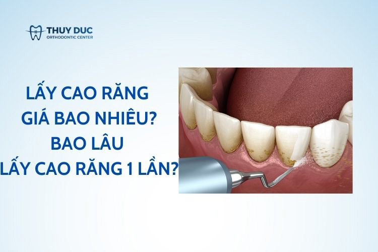 Lấy cao răng giá bao nhiêu? Bao lâu lấy cao răng 1 lần 1 Lấy cao răng giá bao nhiêu? Bao lâu lấy cao răng 1 lần 1