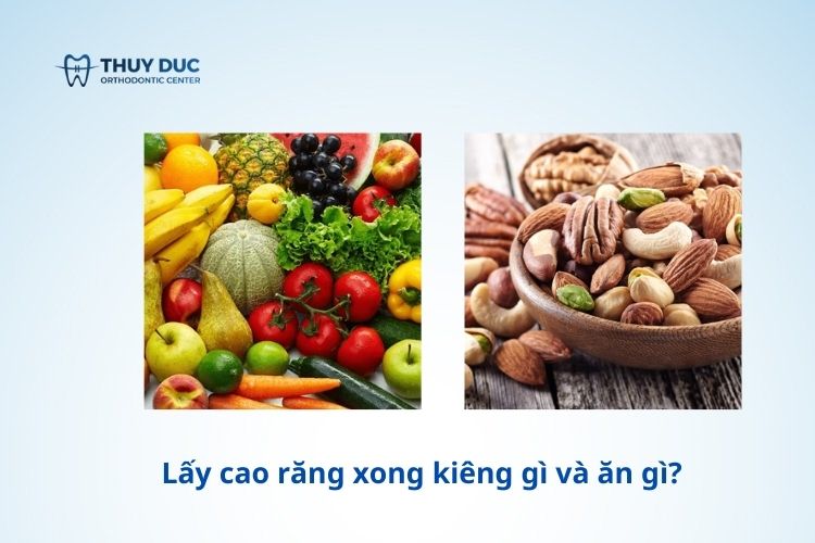 Lấy cao răng xong kiêng gì và ăn gì? 1 Lấy cao răng xong kiêng gì và ăn gì? 1