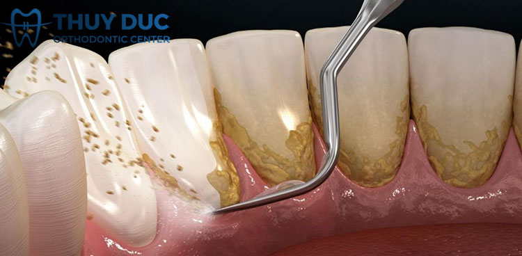 Có nên lấy cao răng thường xuyên không? 1 Có nên lấy cao răng thường xuyên không? 1