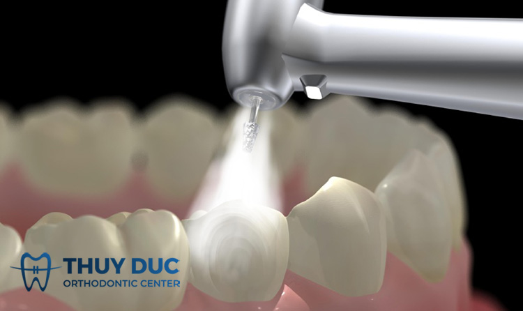 Cạo vôi răng bằng máy siêu âm 1 Cạo vôi răng bằng máy siêu âm 1
