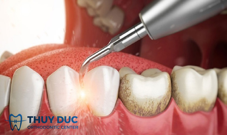 Những yếu tố ảnh hưởng đến chi phí lấy cao răng 1 Những yếu tố ảnh hưởng đến chi phí lấy cao răng 1