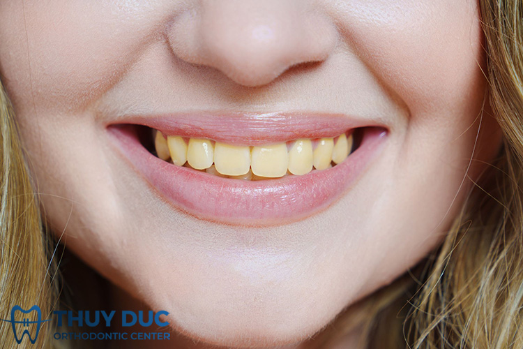 Trường hợp nào nên và không nên đánh bóng răng? 1 Trường hợp nào nên và không nên đánh bóng răng? 1