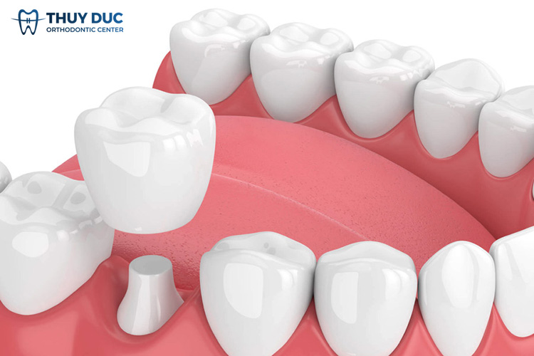 Tìm hiểu kỹ thuật làm răng sứ 1 Tìm hiểu kỹ thuật làm răng sứ 1