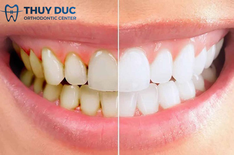 Vừa lấy cao răng vừa tẩy trắng răng được không? 1 Vừa lấy cao răng vừa tẩy trắng răng được không? 1