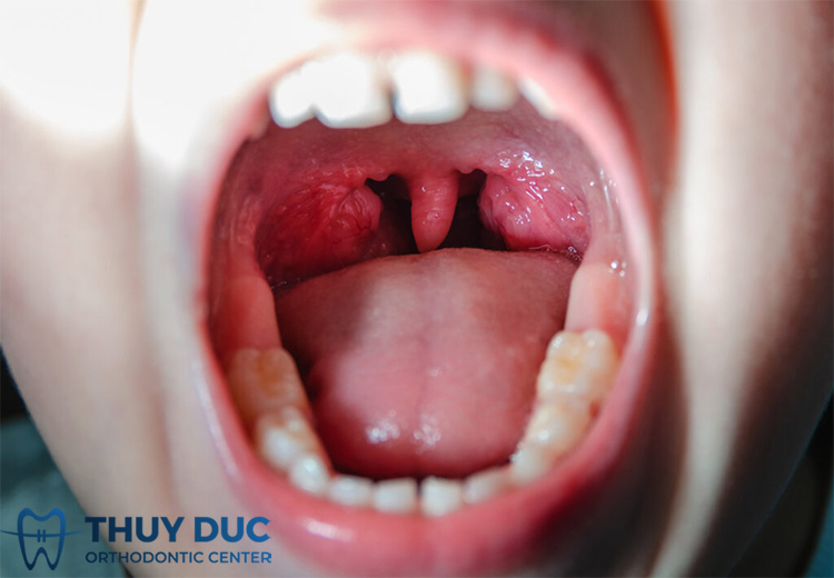 Khi nào cần cắt amidan? 1 Khi nào cần cắt amidan? 1