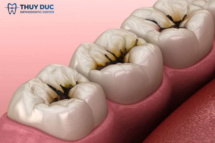 Bệnh sâu răng là gì? 1 Bệnh sâu răng là gì? 1