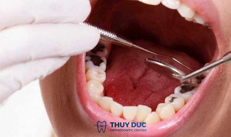 Một số biến chứng khác khi răng khôn mọc đâm vào răng số 7 1 Một số biến chứng khác khi răng khôn mọc đâm vào răng số 7 1