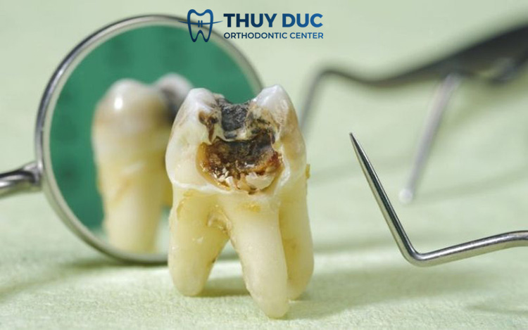 Các biến chứng của bệnh sâu răng 1 Các biến chứng của bệnh sâu răng 1