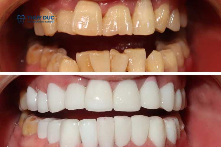 Trị răng ố vàng tại nha khoa 2