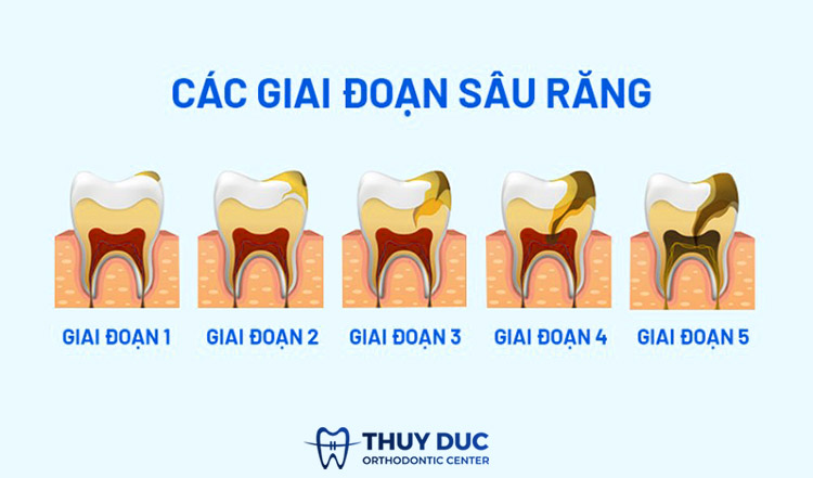 Tìm hiểu các giai đoạn phát triển của bệnh sâu răng 1 Tìm hiểu các giai đoạn phát triển của bệnh sâu răng 1