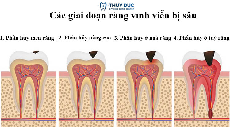 Các giai đoạn khi răng vĩnh viễn bị sâu 1 Các giai đoạn khi răng vĩnh viễn bị sâu 1