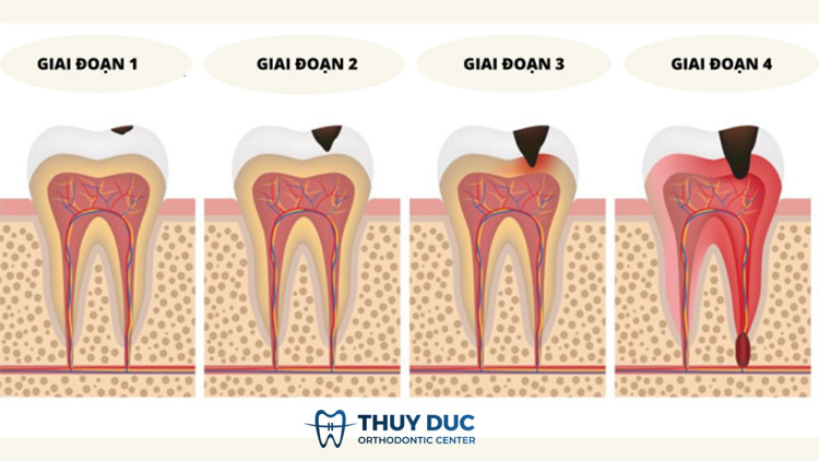 Các giai đoạn phát triển của sâu kẽ răng 1 Các giai đoạn phát triển của sâu kẽ răng 1