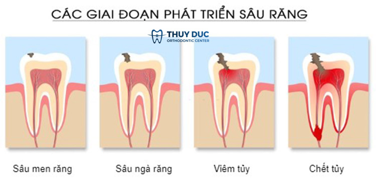 Các mức độ sâu răng khác nhau của răng số 7 1 Các mức độ sâu răng khác nhau của răng số 7 1